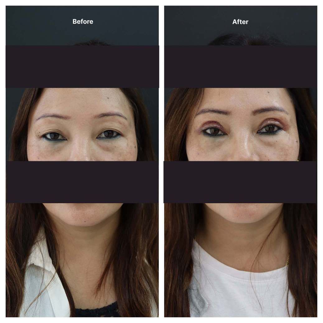 Eyelid Surgery KOQ10